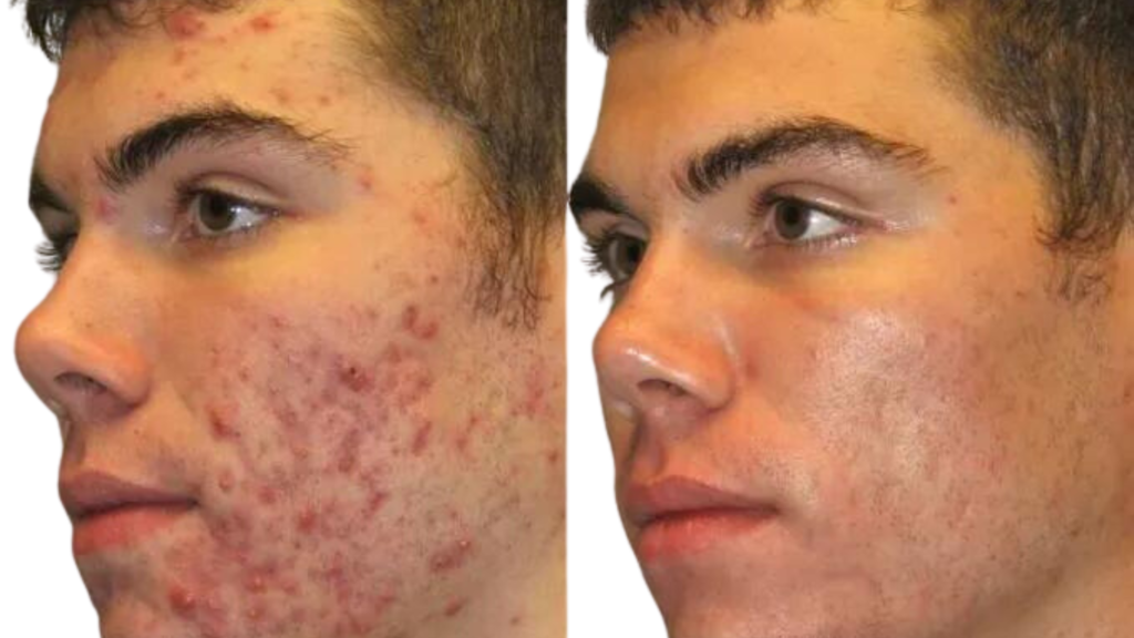 Tratamento para Acne